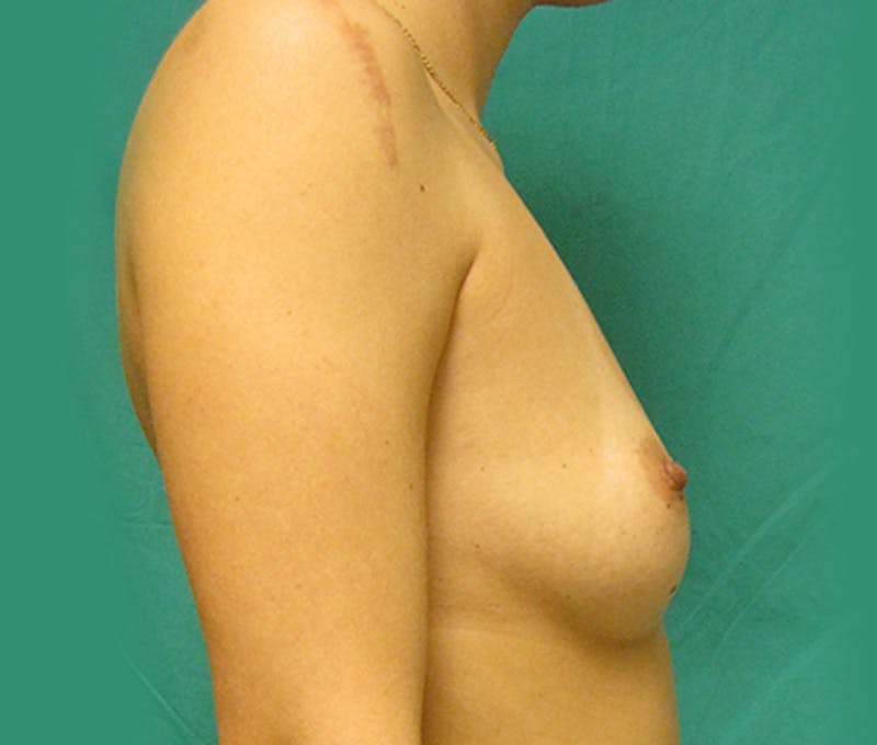 Breast Augmentation Before & After Gallery - Patient 122908796 - Image 5