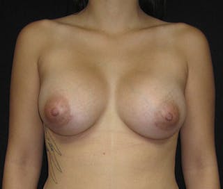 Breast Augmentation Before & After Gallery - Patient 122908810 - Image 2