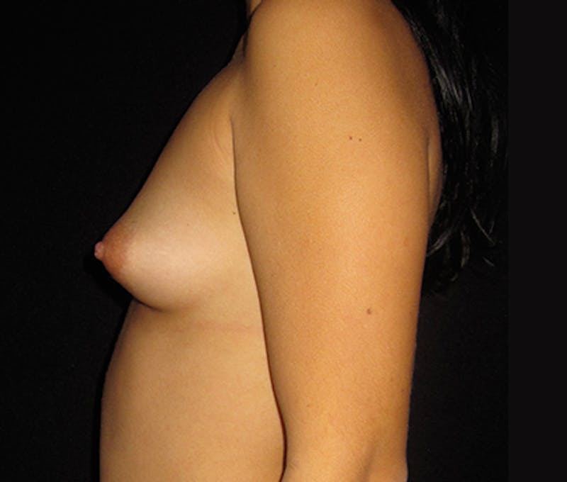Breast Augmentation Before & After Gallery - Patient 122908810 - Image 11