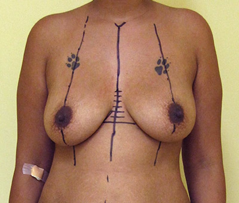 Breast Augmentation Before & After Gallery - Patient 122908814 - Image 1