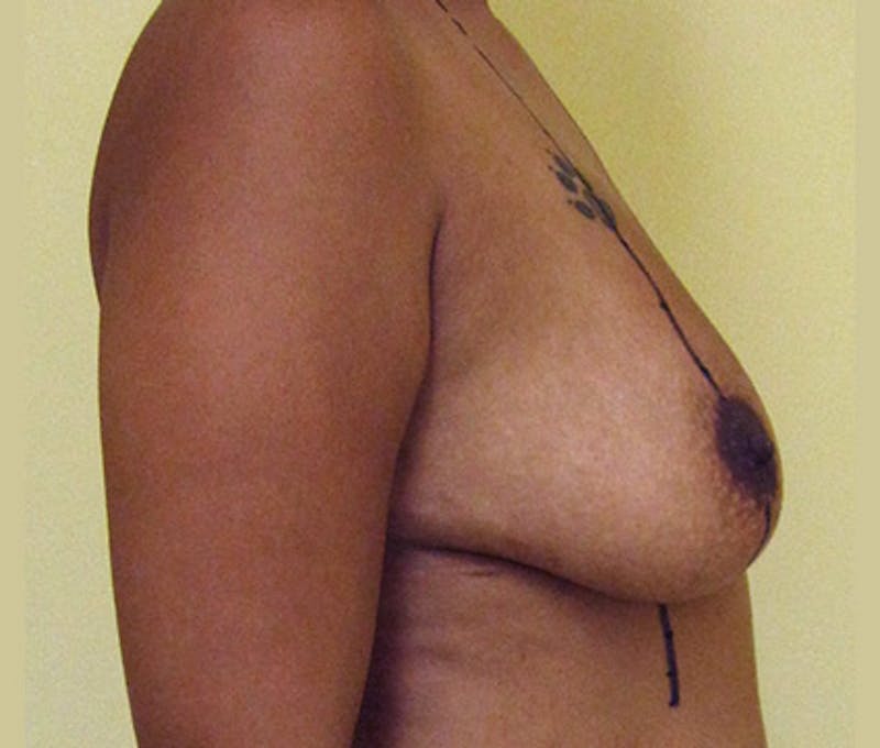 Breast Augmentation Before & After Gallery - Patient 122908814 - Image 5