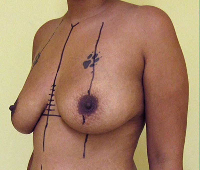 Breast Augmentation Before & After Gallery - Patient 122908814 - Image 7