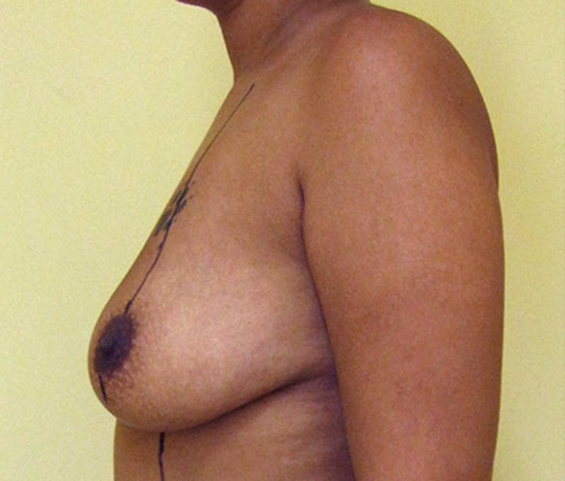 Breast Augmentation Before & After Gallery - Patient 122908814 - Image 9