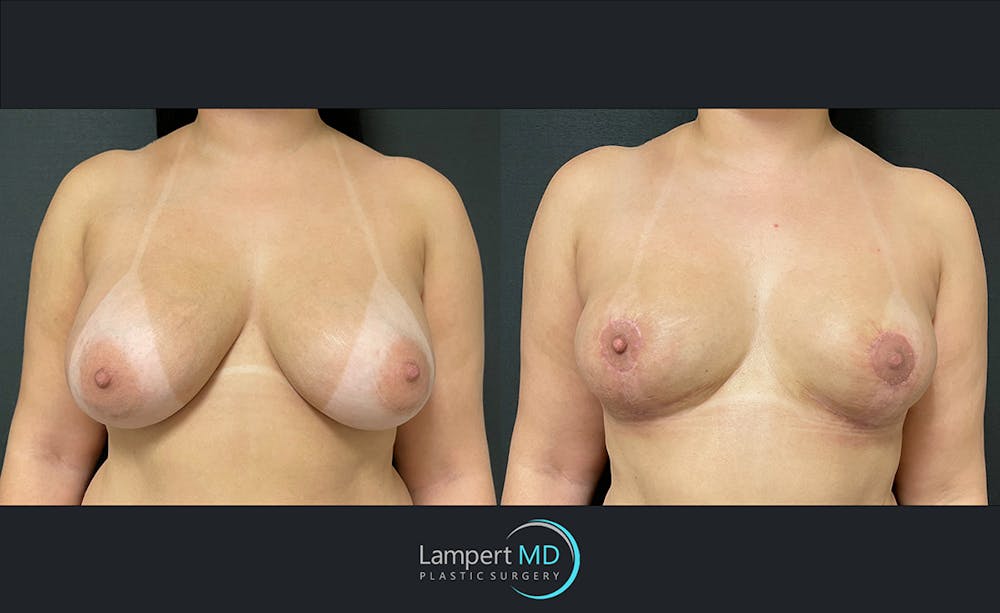 Breast Explant Before & After Gallery - Patient 122908825 - Image 1
