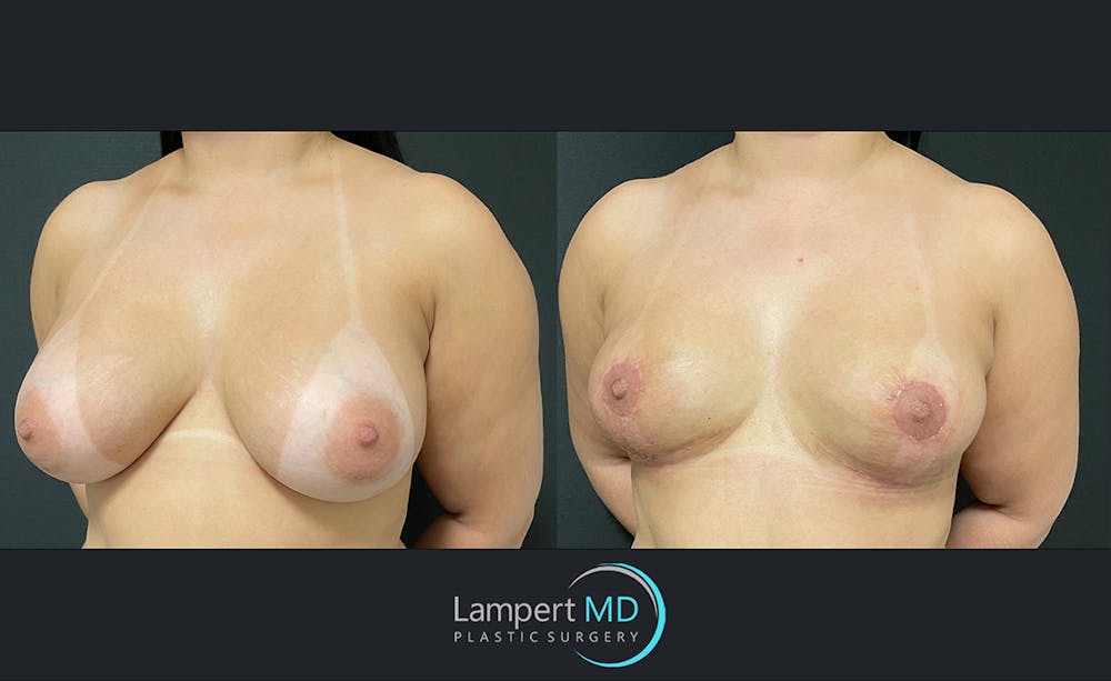 Breast Explant Before & After Gallery - Patient 122908825 - Image 2