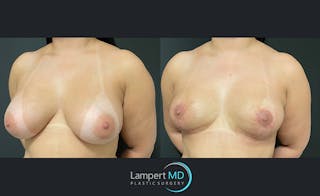 Breast Explant Before & After Gallery - Patient 122908825 - Image 2