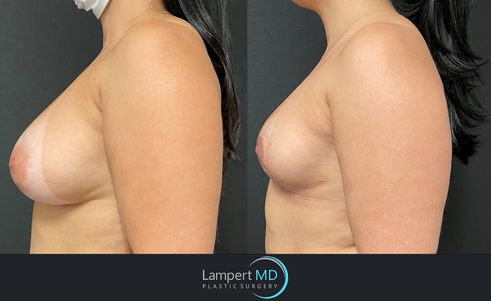 Breast Explant Before & After Gallery - Patient 122908825 - Image 3
