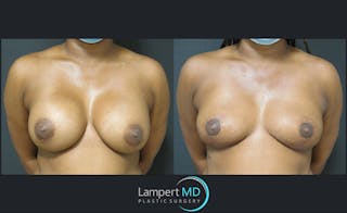 Breast Explant Before & After Gallery - Patient 122908827 - Image 1