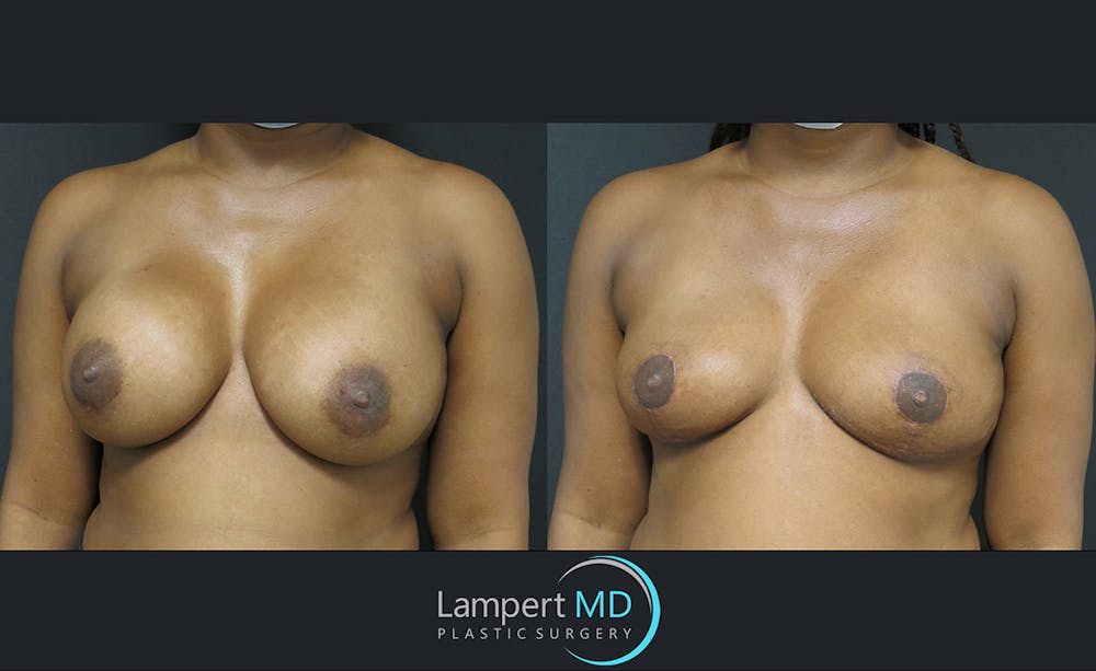 Breast Explant Before & After Gallery - Patient 122908827 - Image 2