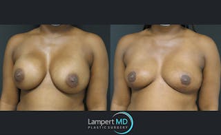 Breast Explant Before & After Gallery - Patient 122908827 - Image 2
