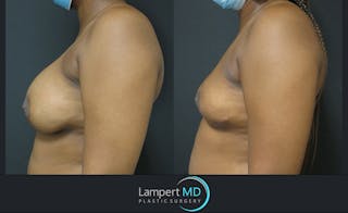 Breast Explant Before & After Gallery - Patient 122908827 - Image 3