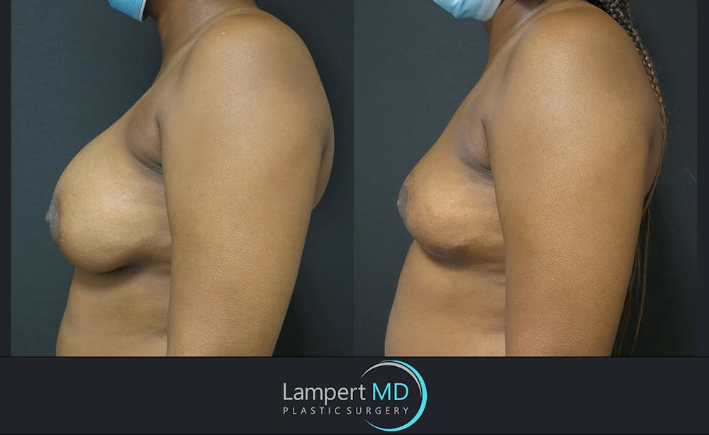 Breast Explant Before & After Gallery - Patient 122908827 - Image 3