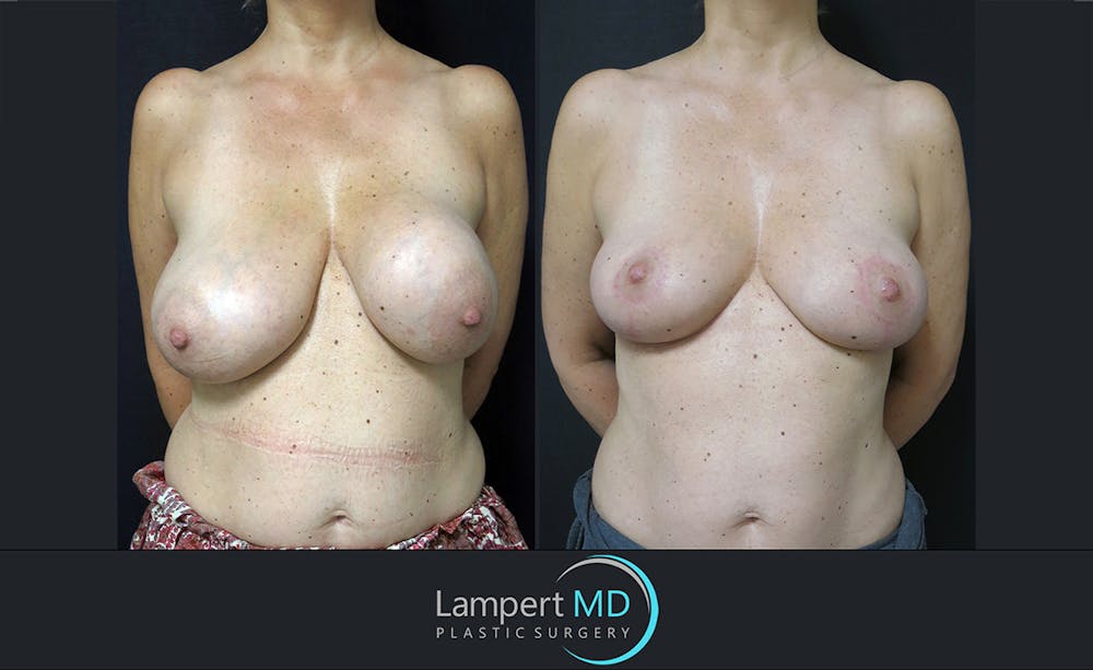 Breast Explant Before & After Gallery - Patient 122908830 - Image 1