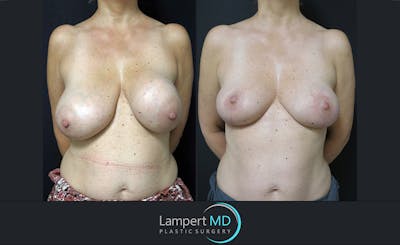 Breast Explant Before & After Gallery - Patient 122908830 - Image 1