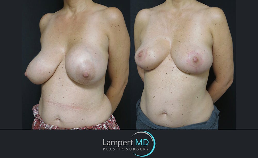 Breast Explant Before & After Gallery - Patient 122908830 - Image 2