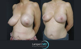 Breast Explant Before & After Gallery - Patient 122908830 - Image 2