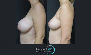 Breast Explant Before & After Gallery - Patient 122908830 - Image 3
