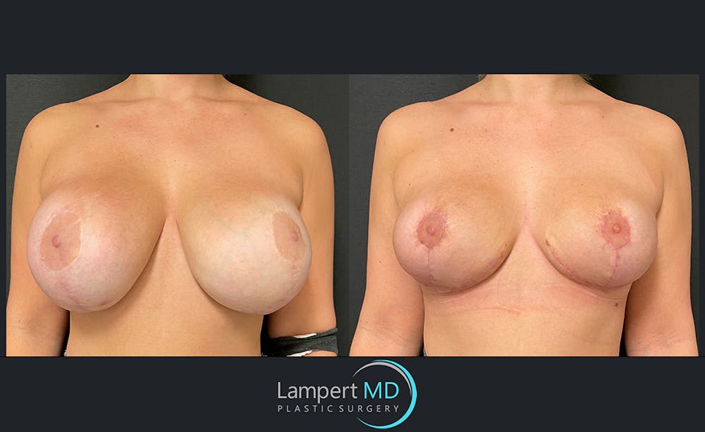 Breast Explant Before & After Gallery - Patient 122908835 - Image 1