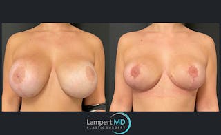 Breast Explant Before & After Gallery - Patient 122908835 - Image 1