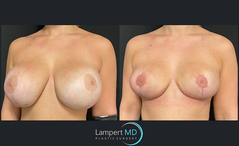 Breast Explant Before & After Gallery - Patient 122908835 - Image 2