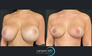 Breast Explant Before & After Gallery - Patient 122908835 - Image 2