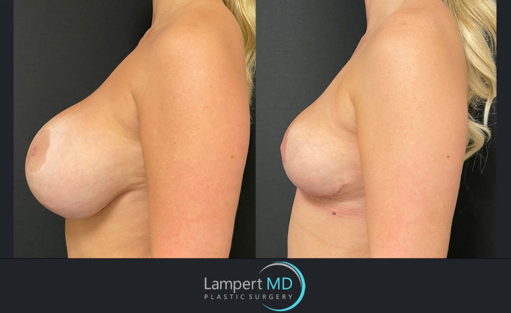 Breast Explant Before & After Gallery - Patient 122908835 - Image 3