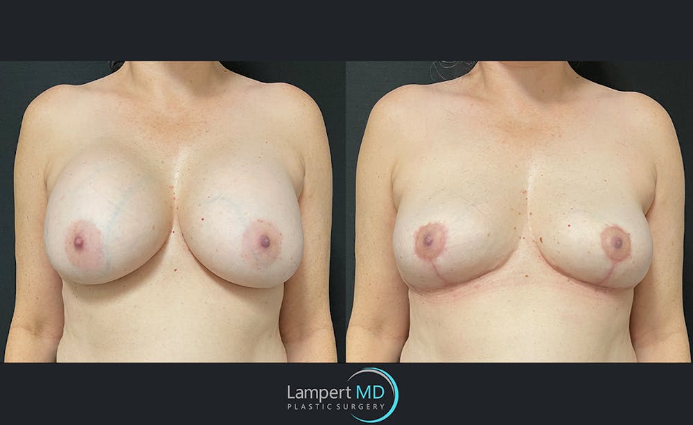 Breast Explant Before & After Gallery - Patient 122908840 - Image 1