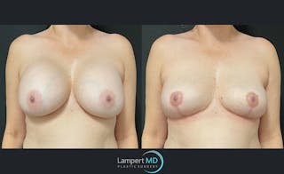 Breast Explant Before & After Gallery - Patient 122908840 - Image 1