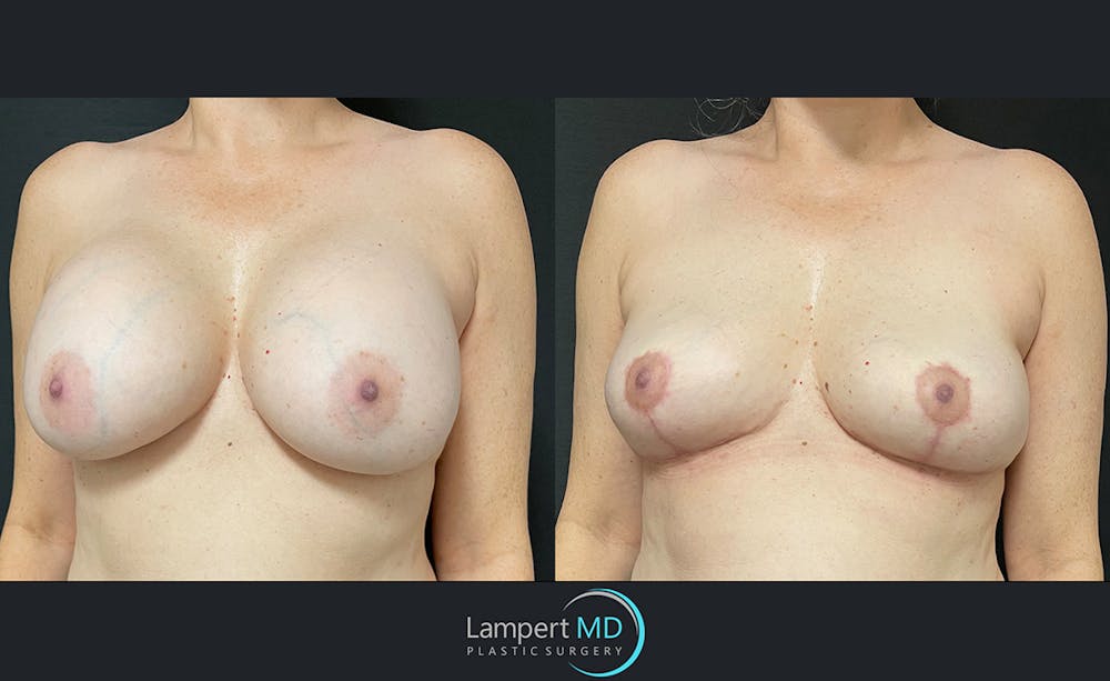 Breast Explant Before & After Gallery - Patient 122908840 - Image 2
