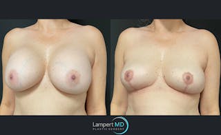 Breast Explant Before & After Gallery - Patient 122908840 - Image 2