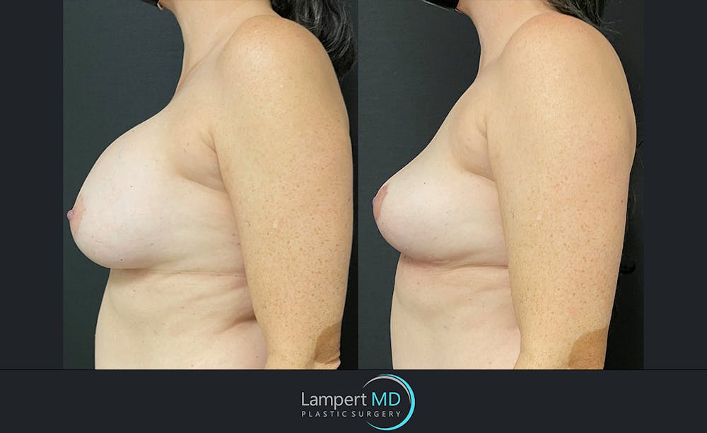 Breast Explant Before & After Gallery - Patient 122908840 - Image 3
