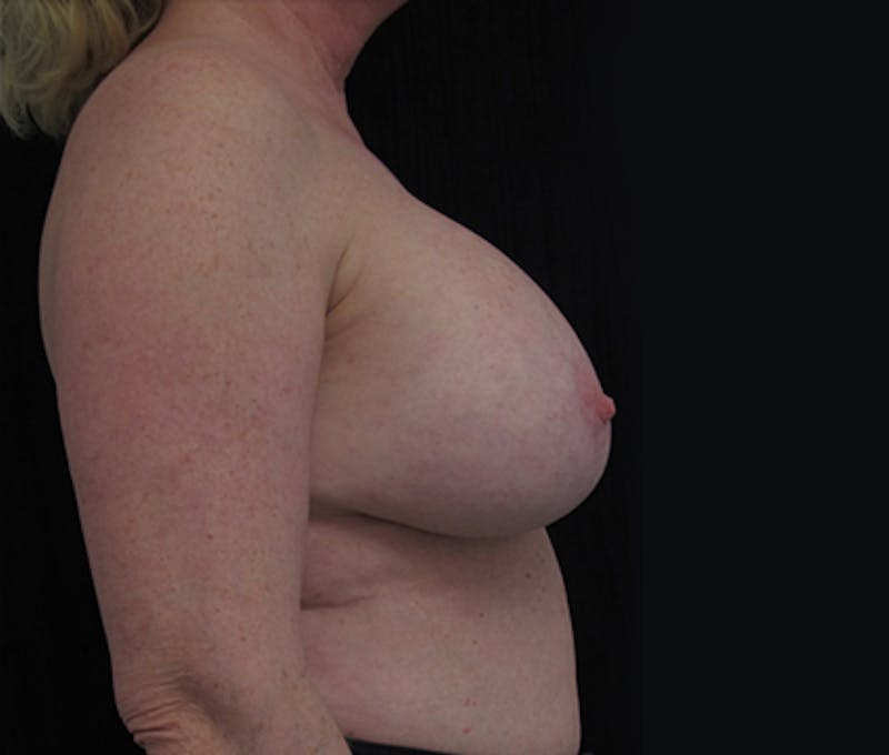 Breast Augmentation Before & After Gallery - Patient 122908841 - Image 10