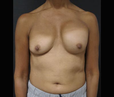 Breast Augmentation Before & After Gallery - Patient 122908843 - Image 1