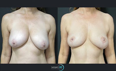 Breast Explant Before & After Gallery - Patient 122908842 - Image 1