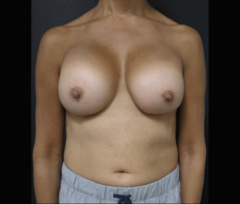 Breast Augmentation Before & After Gallery - Patient 122908843 - Image 2