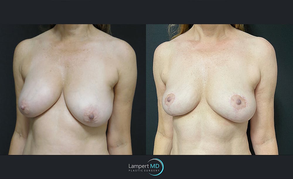 Breast Explant Before & After Gallery - Patient 122908842 - Image 2