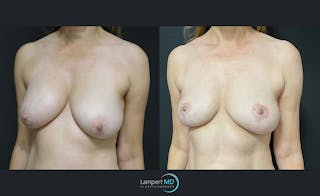 Breast Explant Before & After Gallery - Patient 122908842 - Image 2