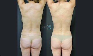 Breast Explant Before & After Gallery - Patient 122908842 - Image 4