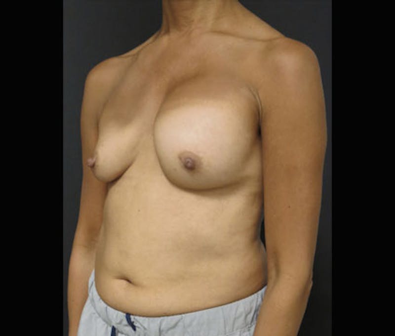 Breast Augmentation Before & After Gallery - Patient 122908843 - Image 7
