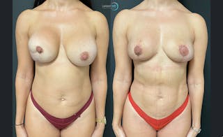 Breast Explant Before & After Gallery - Patient 122908844 - Image 1