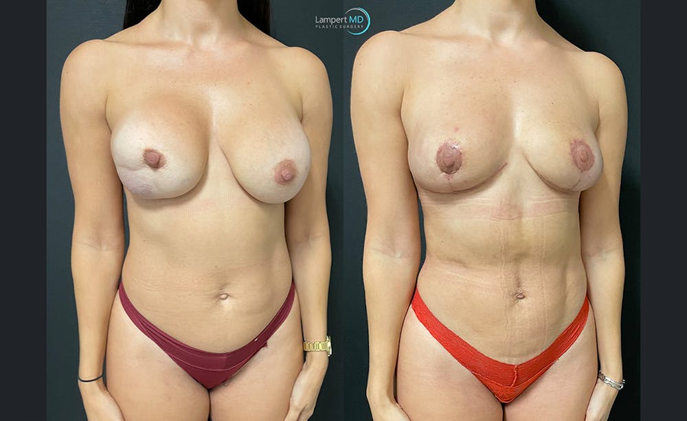 Breast Explant Before & After Gallery - Patient 122908844 - Image 2