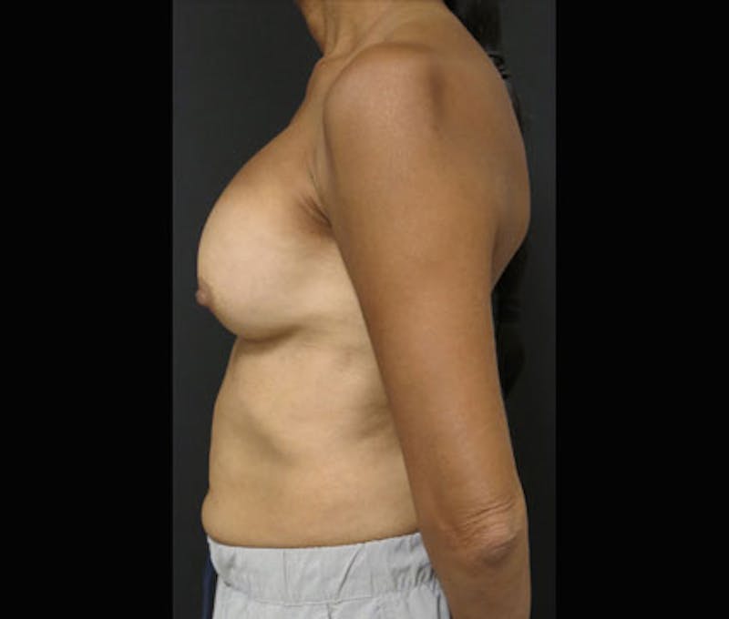 Breast Augmentation Before & After Gallery - Patient 122908843 - Image 9