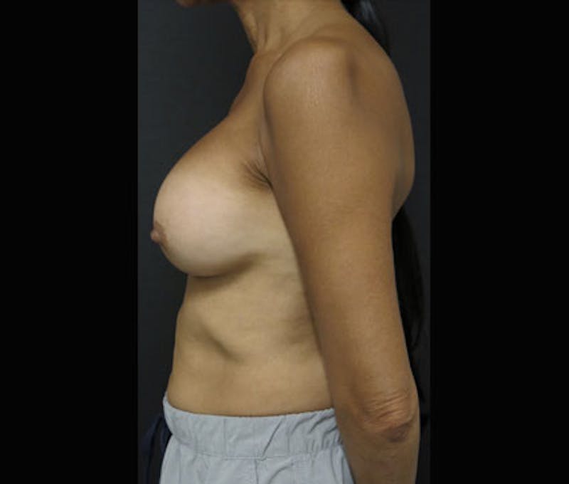 Breast Augmentation Before & After Gallery - Patient 122908843 - Image 10