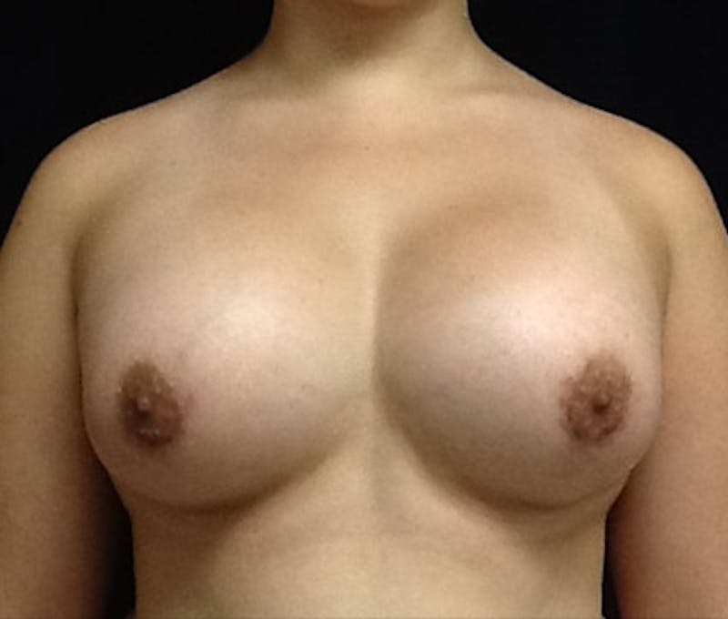 Breast Augmentation Before & After Gallery - Patient 122908846 - Image 2