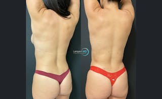 Breast Reconstruction Before & After Gallery - Patient 268473 - Image 4