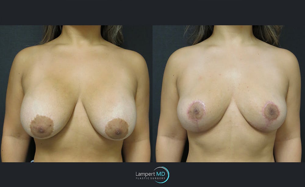 Breast Explant Before & After Gallery - Patient 122908845 - Image 1