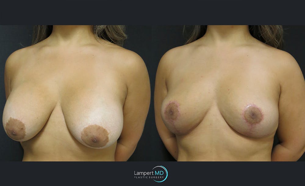 Breast Explant Before & After Gallery - Patient 122908845 - Image 2