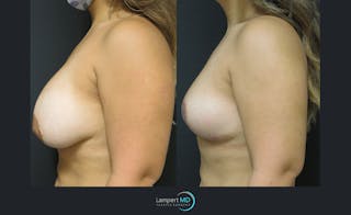 Breast Explant Before & After Gallery - Patient 122908845 - Image 3