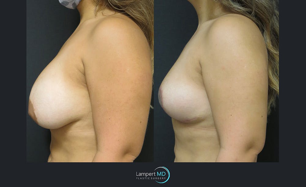 Breast Explant Before & After Gallery - Patient 122908845 - Image 3