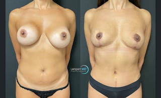 Breast Explant Before & After Gallery - Patient 122908847 - Image 1